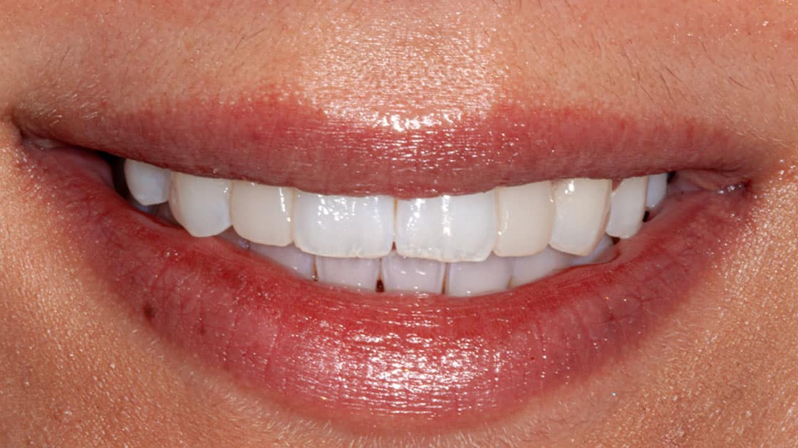 AMIRA Porcelain Veneers AFTER SMILE