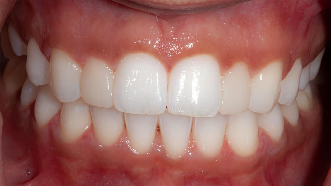 AMIRA Porcelain Veneers AFTER TEETH