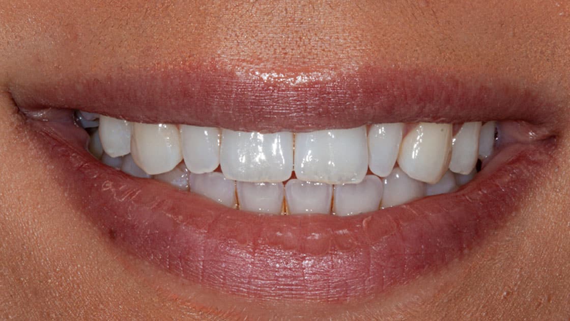 AMIRA Porcelain Veneers BEFORE SMILE