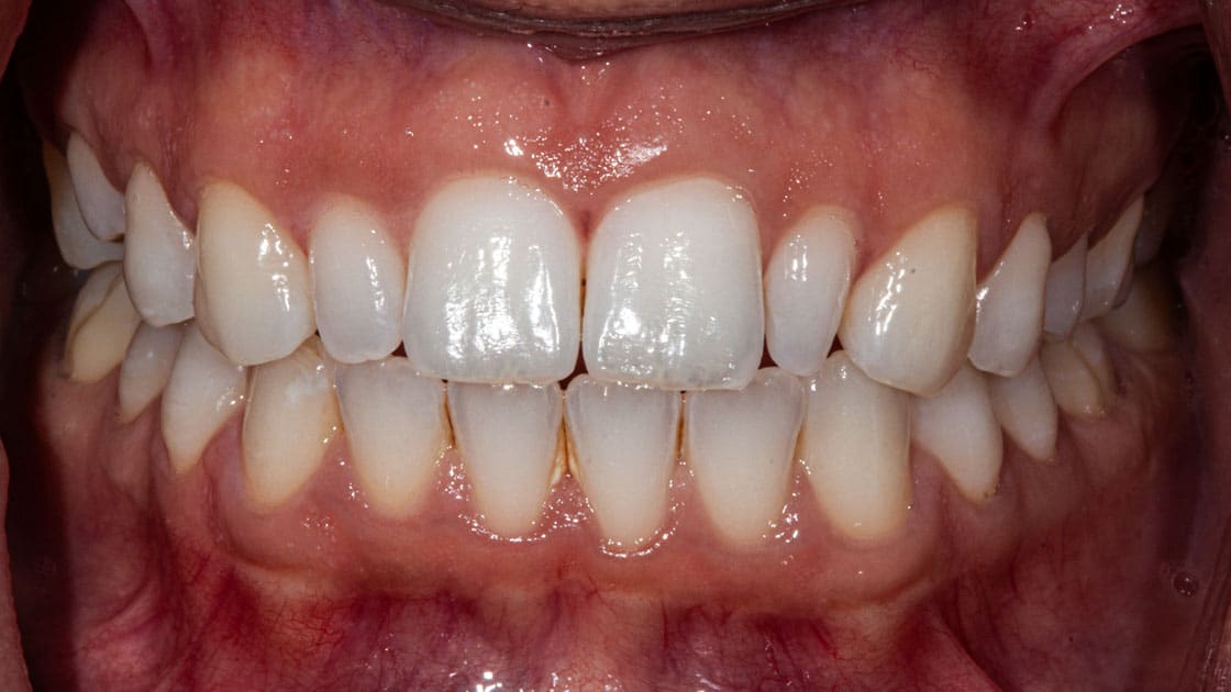 AMIRA Porcelain Veneers BEFORE TEETH
