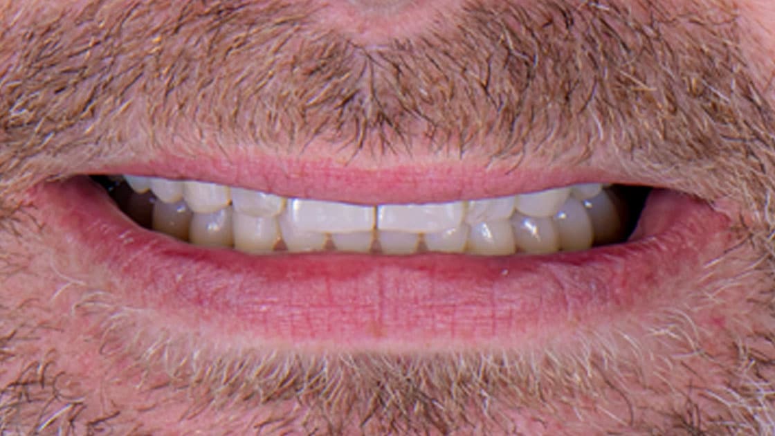 ANTHONY Porcelain Veneers AFTER Smile