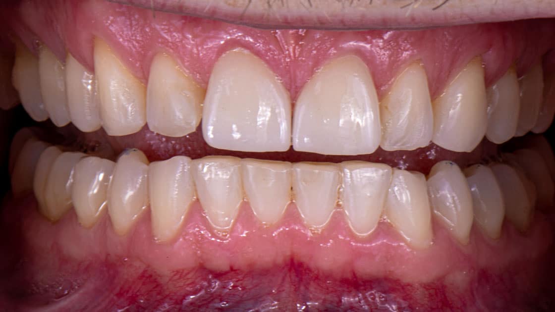 ANTHONY Porcelain Veneers AFTER TEETH