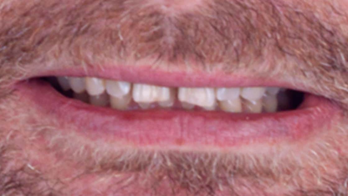 ANTHONY Porcelain Veneers BEFORE SMILE