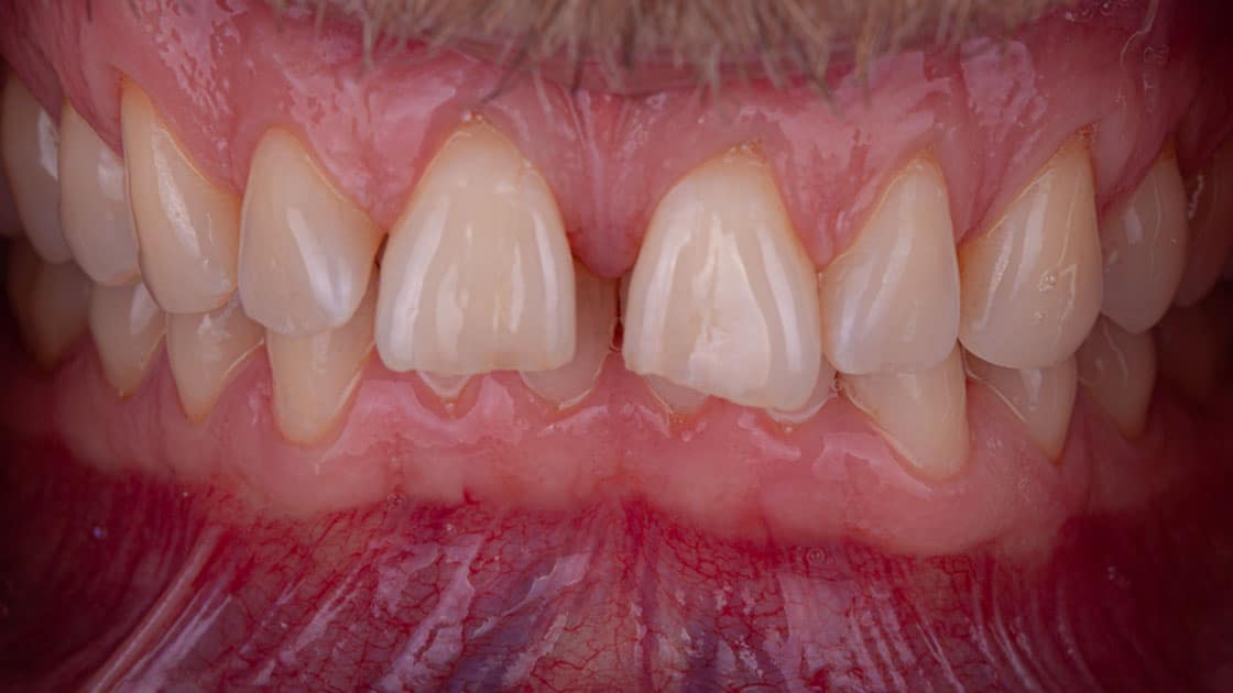 ANTHONY Porcelain Veneers BEFORE TEETH