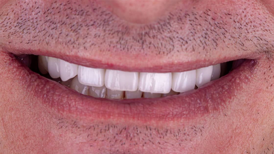 Adam Porcelain Veneers AFTER SMILE
