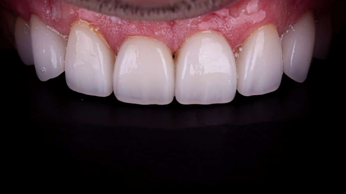 Adam Porcelain Veneers AFTER TEETH