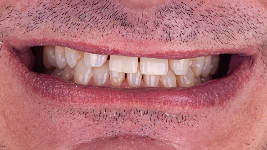 Adam Porcelain Veneers BEFORE SMILE