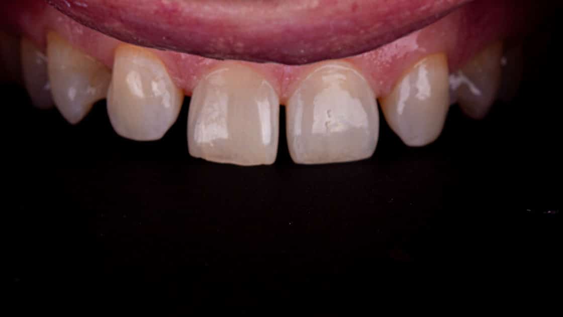 Adam Porcelain Veneers BEFORE TEETH