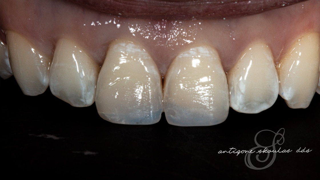 Composite Veneers After Photo