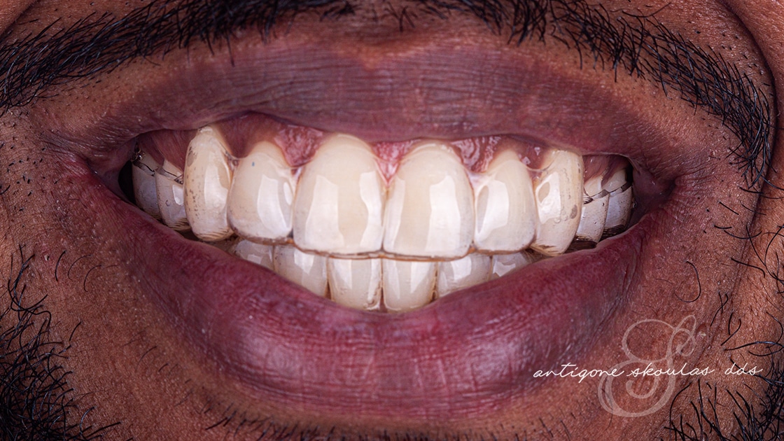 Invisalign After Photo 1
