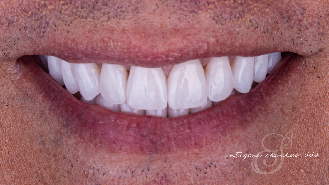 Porcelain Crowns After Photo