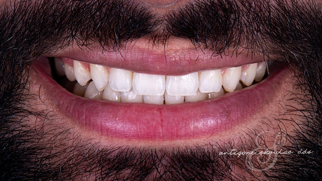 Invisalign After Photo 2