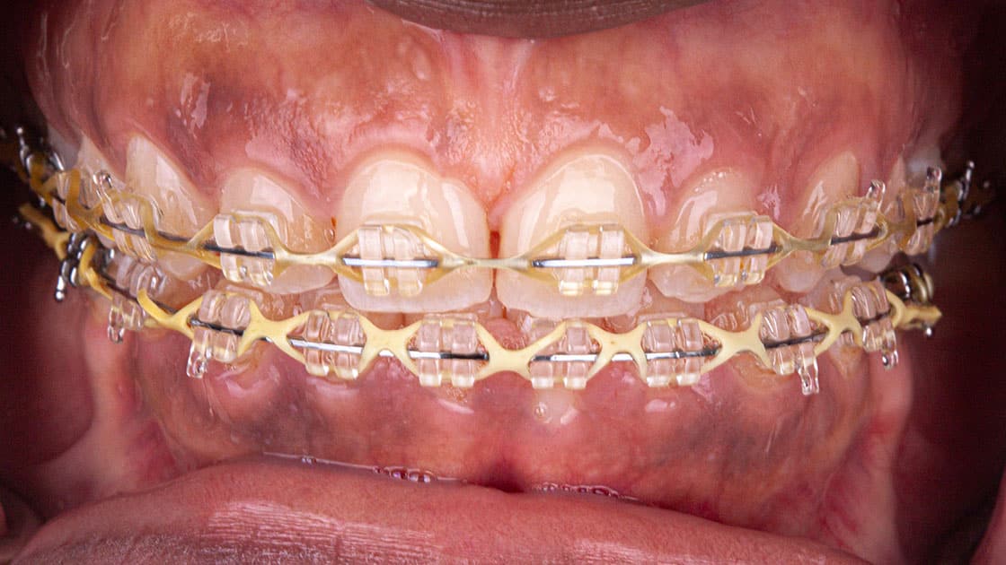 Anthonia teeth before gummy
