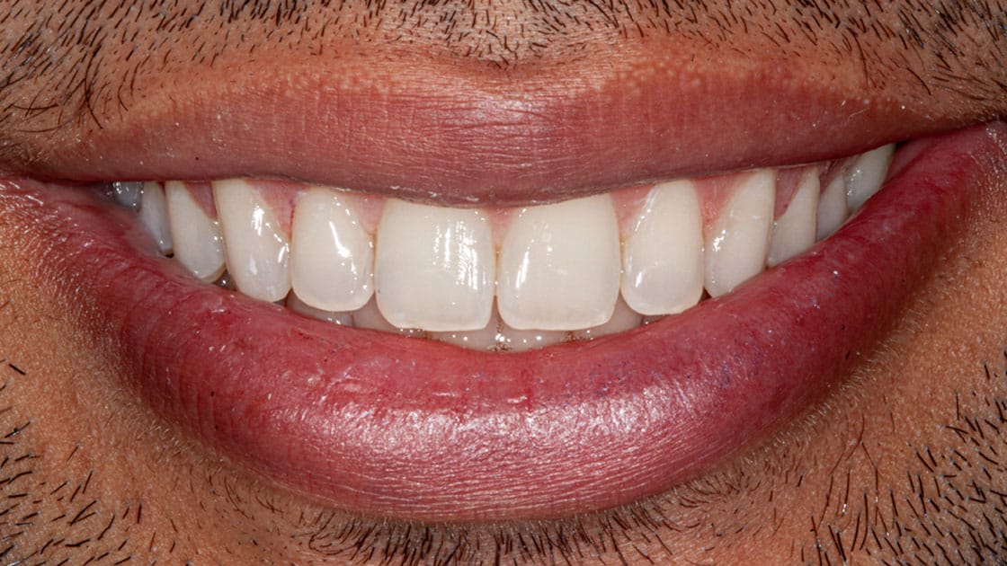 Arham-Invisalign-AFTER-SMILE