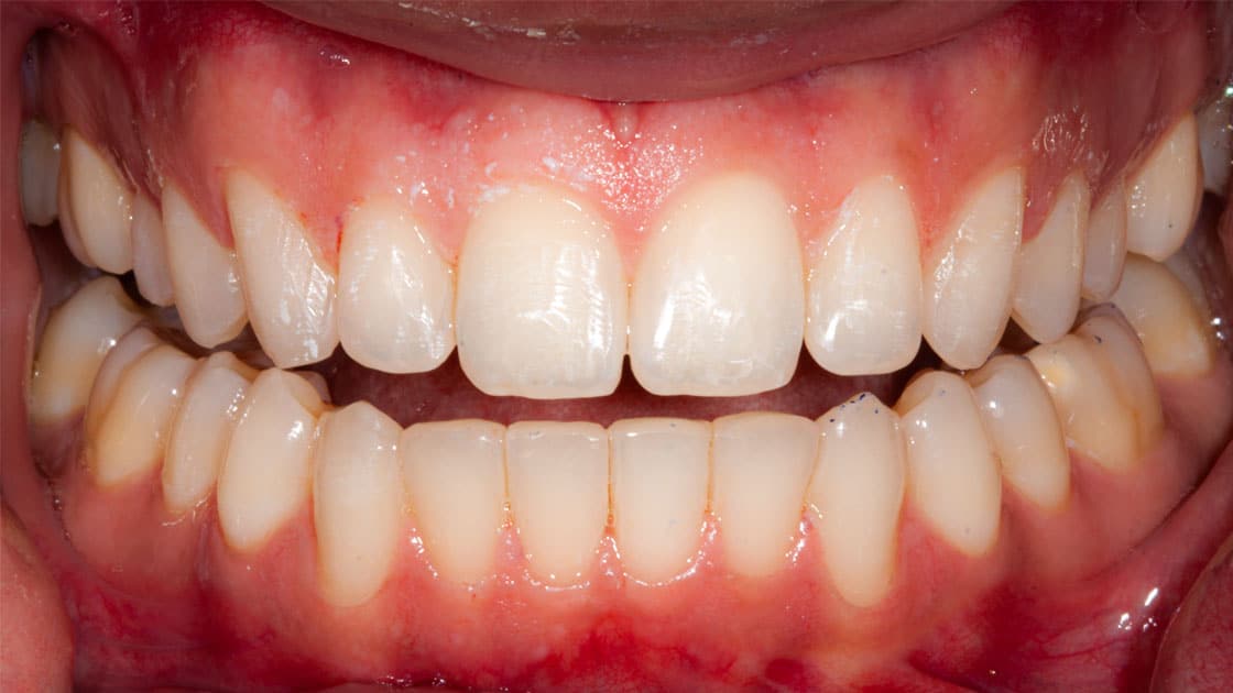 Arham-Invisalign-AFTER-teeth