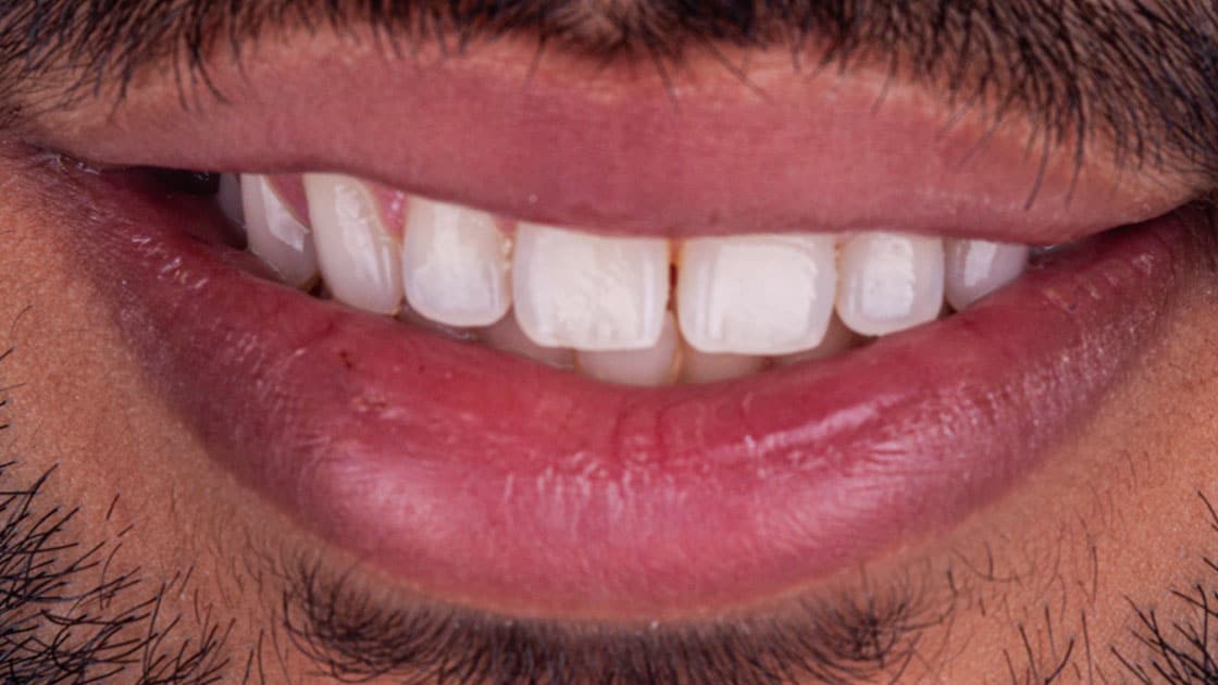 Arham-Invisalign-BEFORE-SMILE