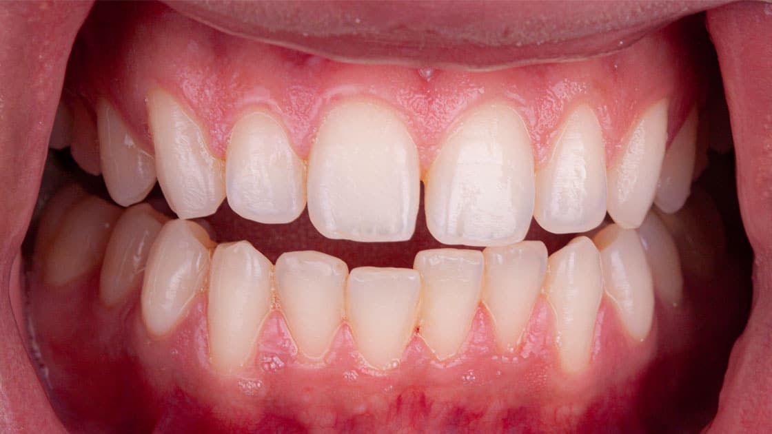 Arham-Invisalign-BEFORE-teeth