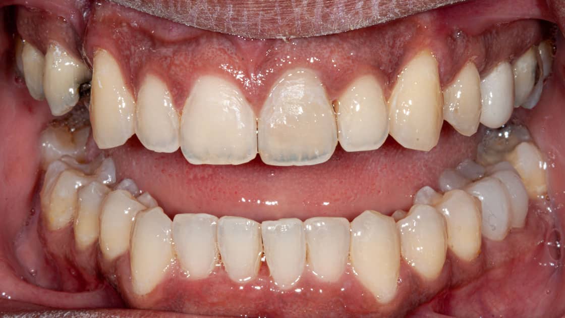 Artist Invisalign after teeth