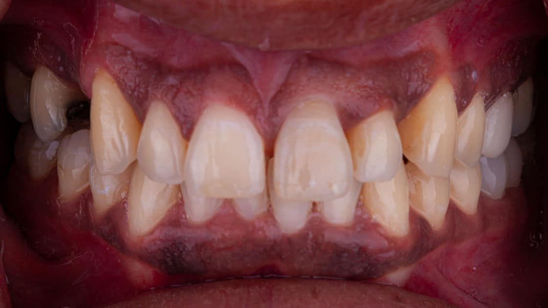 Artist Invisalign before teeth