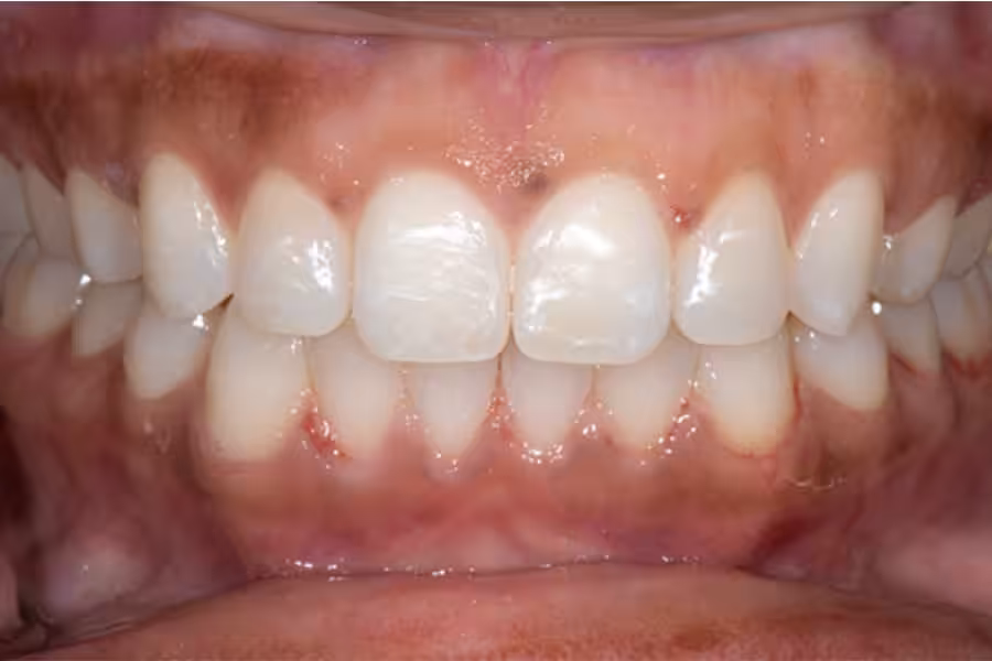Invisalign Final Photo