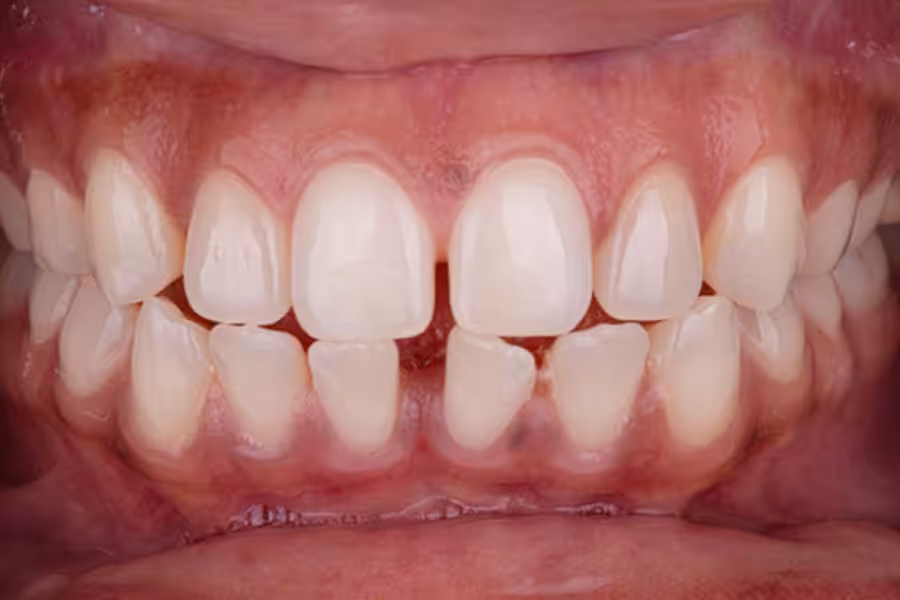 Invisalign Initial Photo