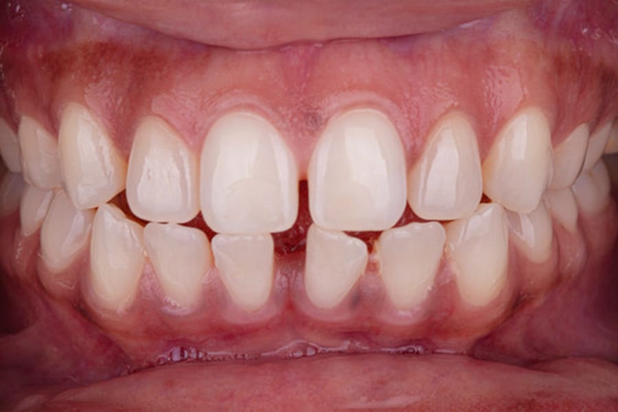 Invisalign Initial Photo