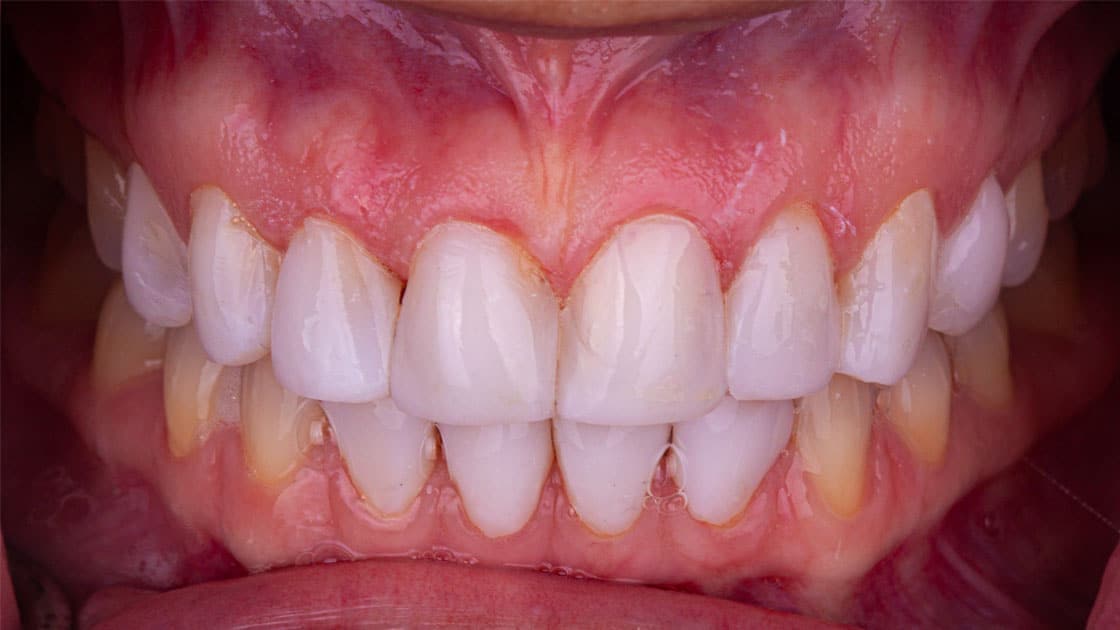 Ashley-Composite Veneers-After-TEETH