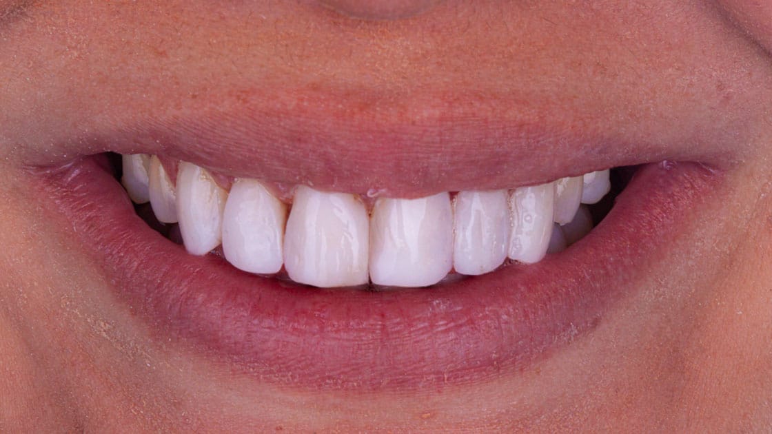 Ashley-Composite Veneers-After-Smile