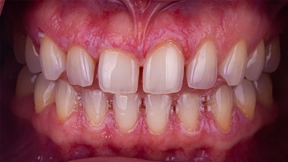 Ashley-Composite Veneers-Before-TEETH