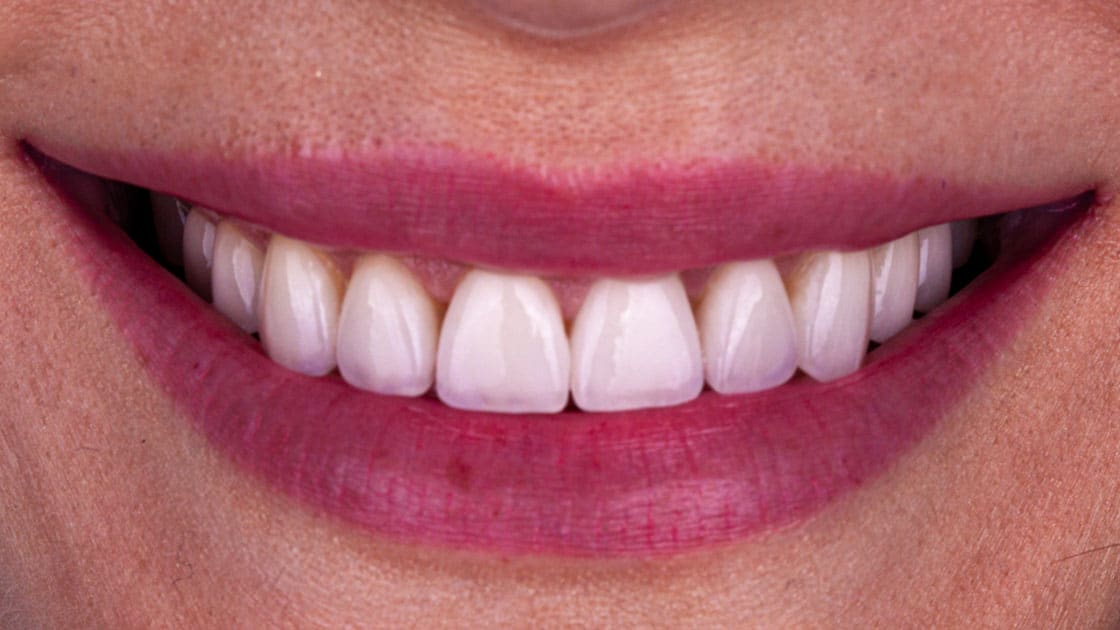 BETH Porcelain Veneers AFTER SMILE