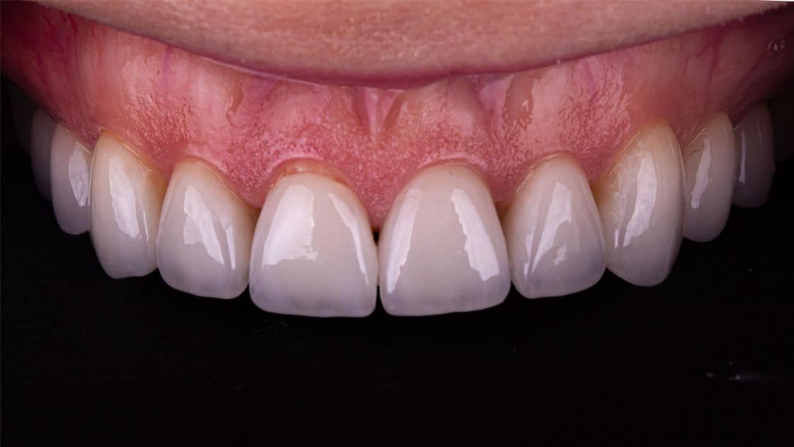 BETH Porcelain Veneers AFTER TEETH