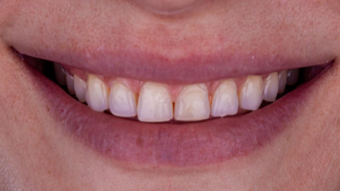 BETH Porcelain Veneers BEFORE SMILE