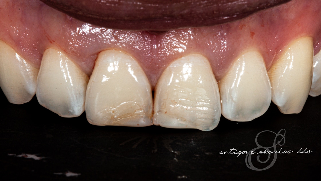 Composite Veneers Before Photo