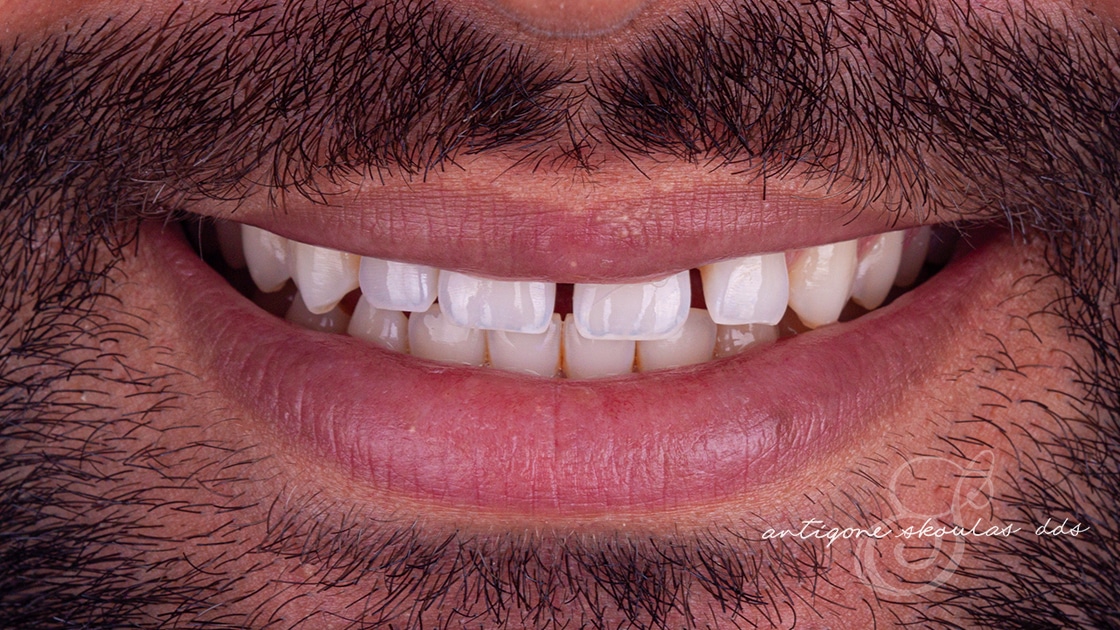Invisalign Before Photo 2