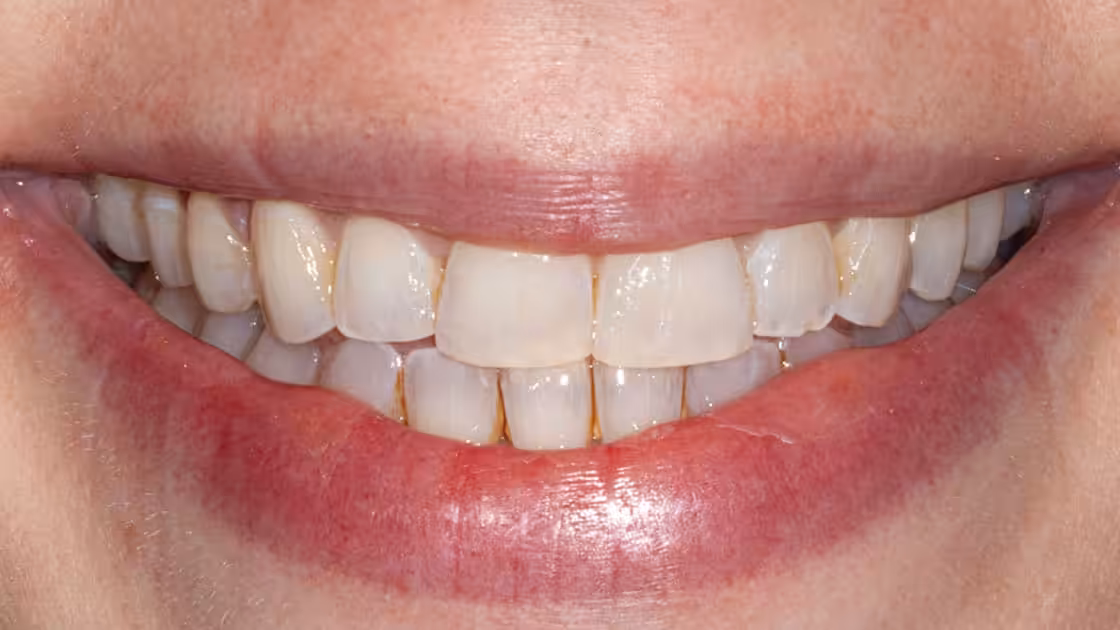 Case 6-AFTER-SMILE