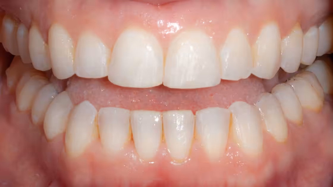 Case 6-AFTER-TEETH
