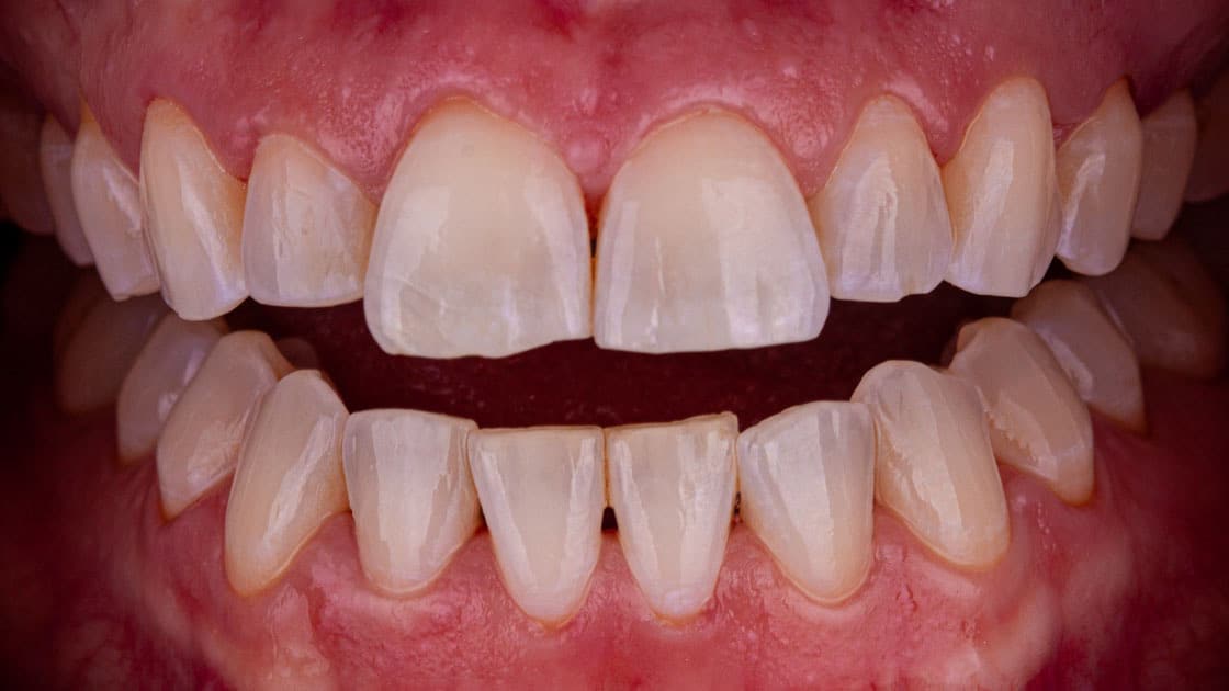 Case 6-BEFORE-TEETH