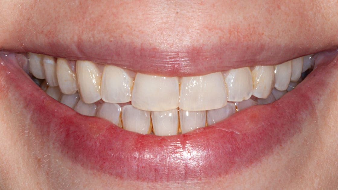 DARA-Invisalign-AFTER-SMILE