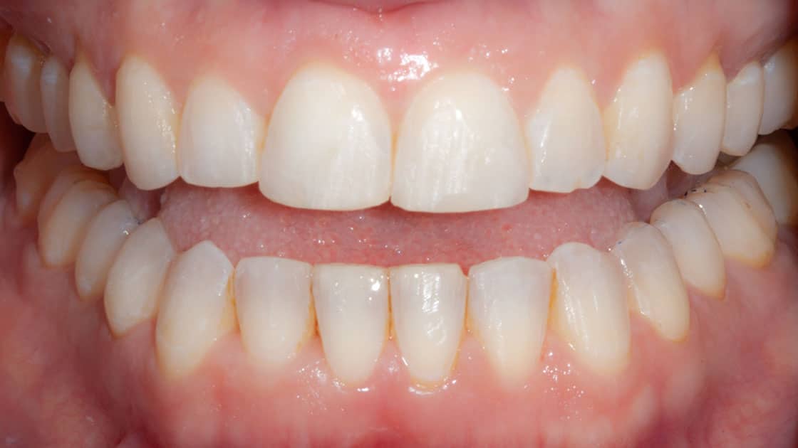 DARA-Invisalign-AFTER-TEETH