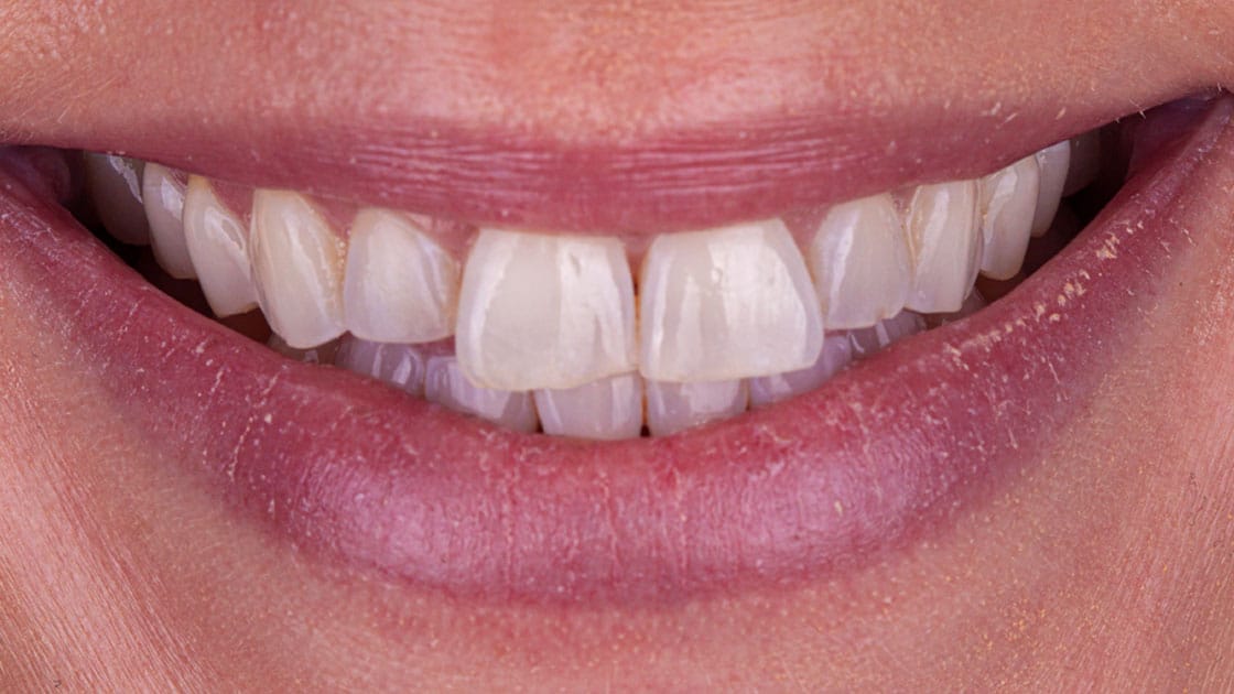 DARA-Invisalign-BEFORE-SMILE