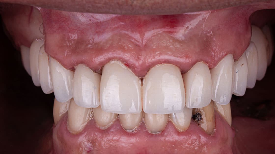 Porcelain Crowns AFTER TEETH