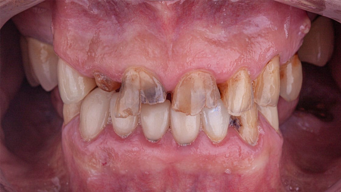Porcelain Crowns BEFORE TEETH