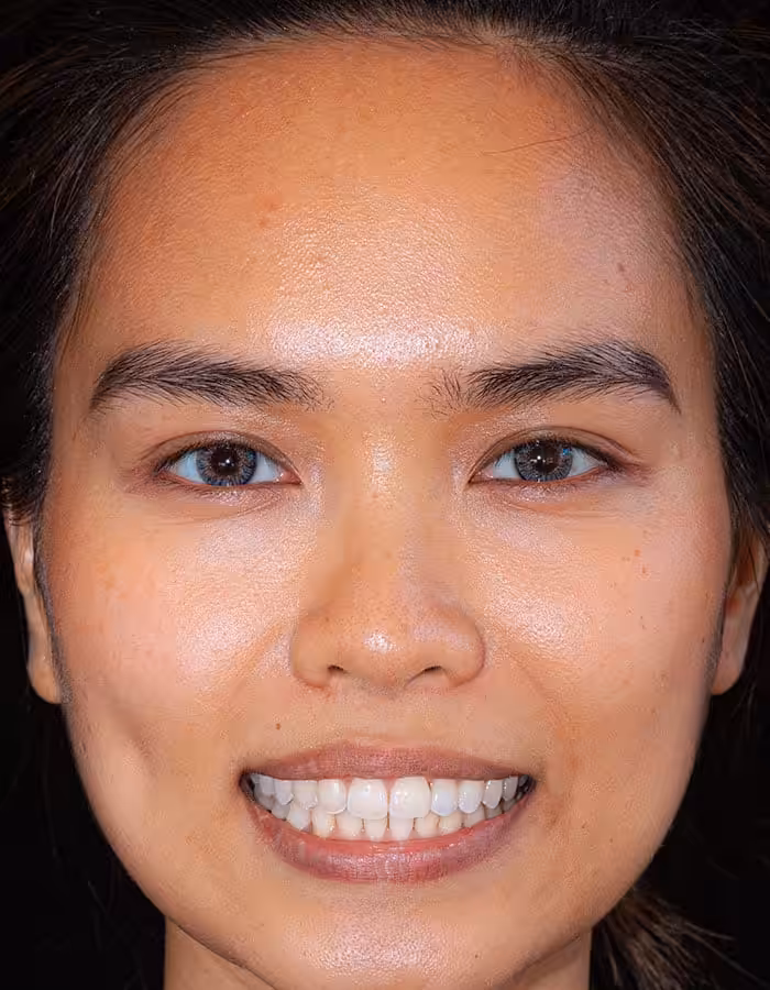Case 3 after face
