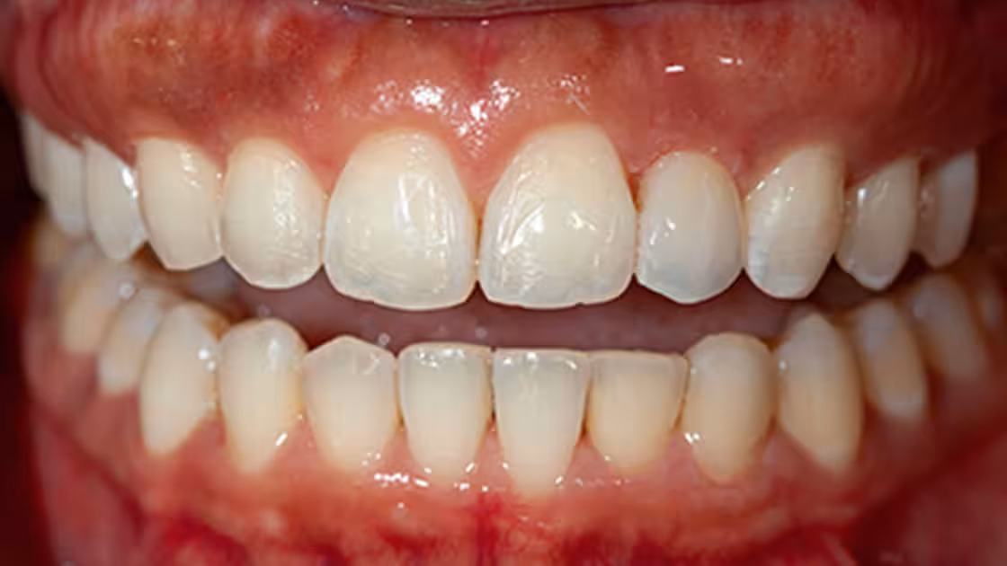 Case 3 -after-teeth