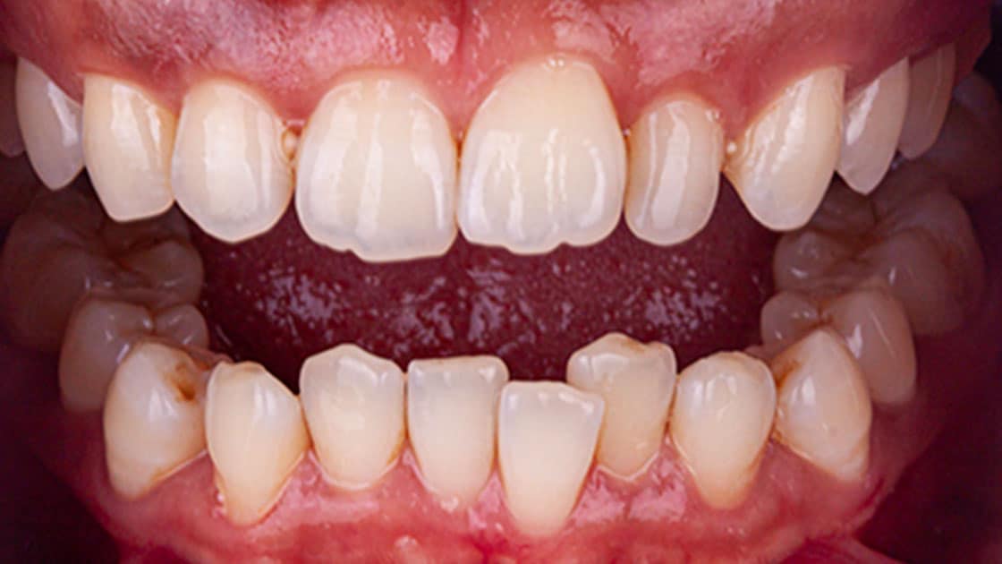 Diep-before-teeth