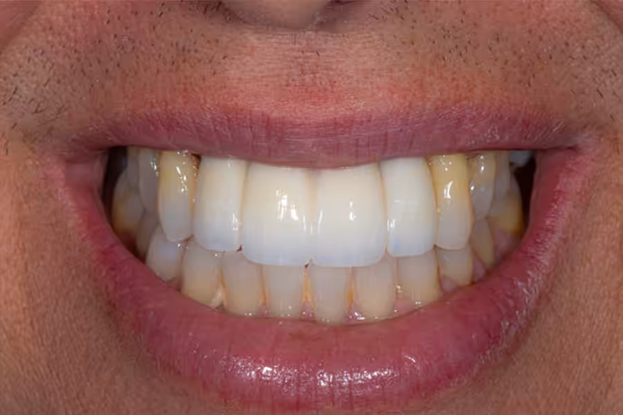 Implants Final Photo