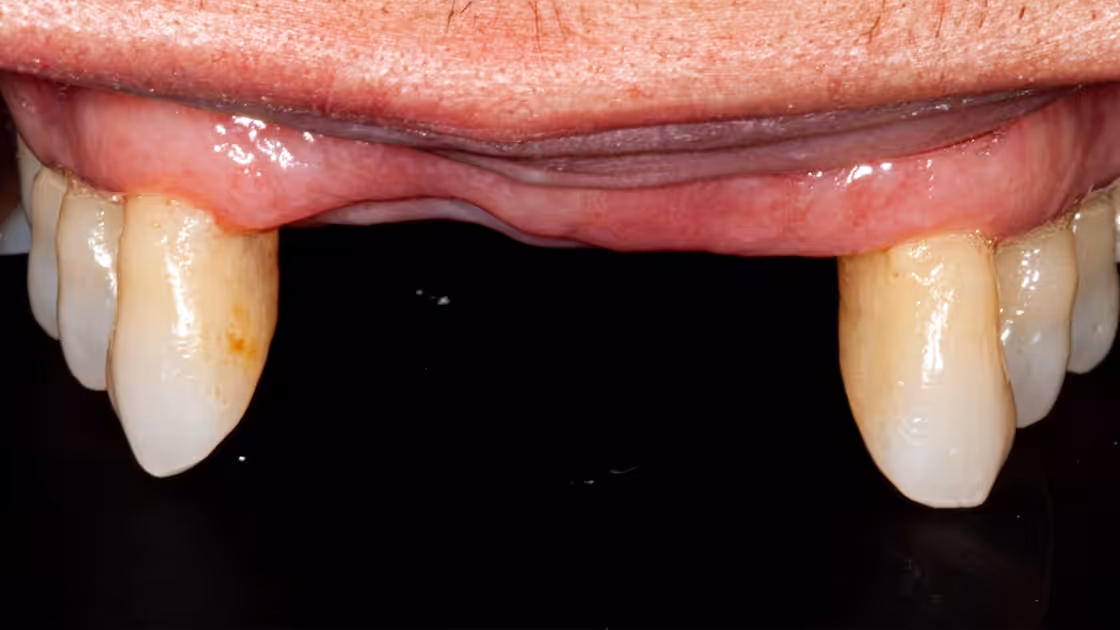 Case 2 During Implant Treatment