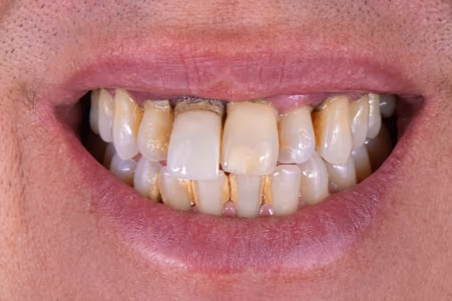 Case 2 Implants Initial Photo