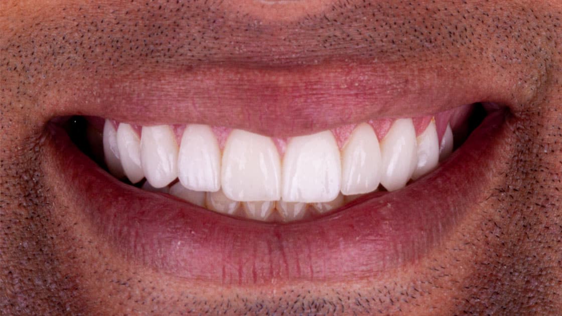 GRANT Porcelain Veneers AFTER SMILE