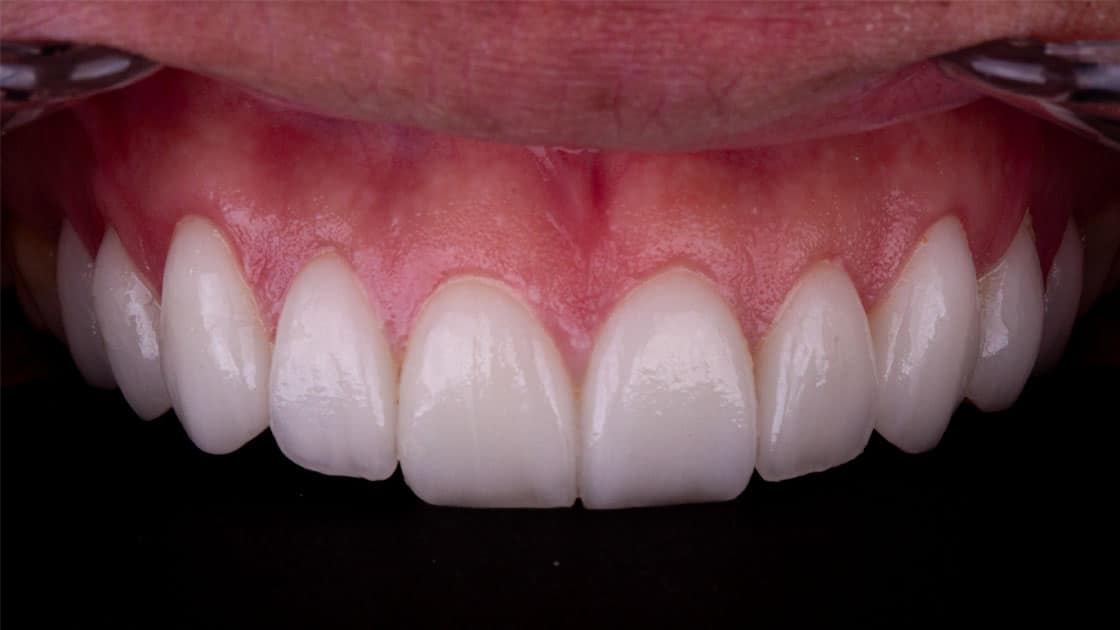 GRANT Porcelain Veneers AFTER TEETH